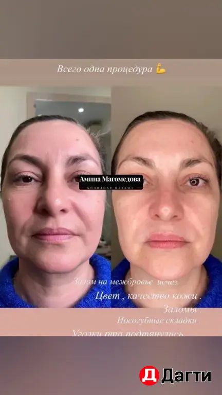 массаж , Холодная плазма