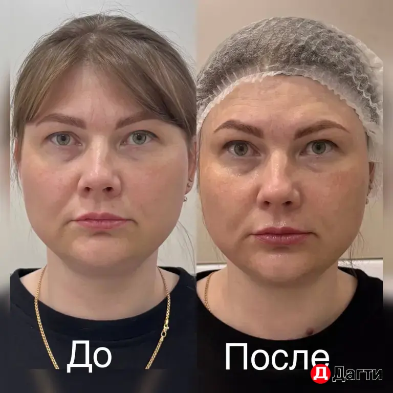 массаж , Холодная плазма