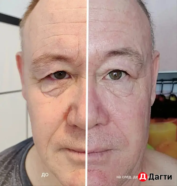 массаж , Холодная плазма