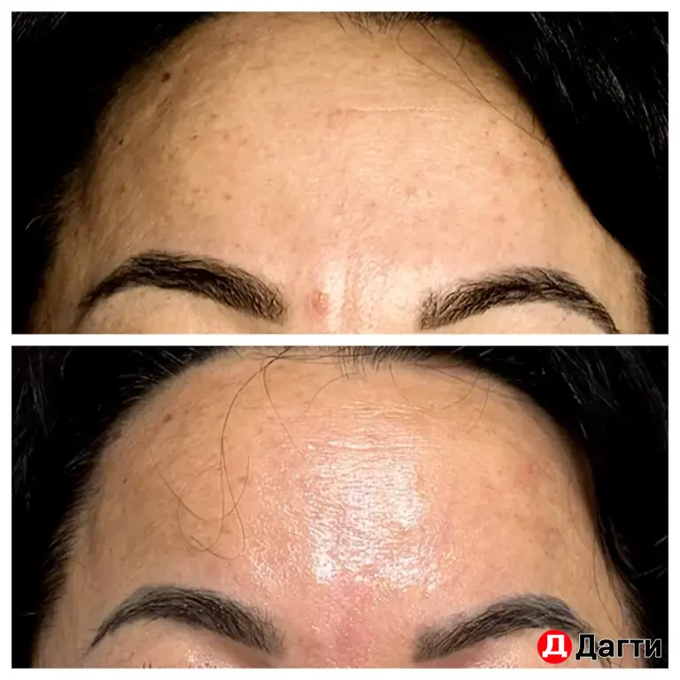 массаж , Холодная плазма