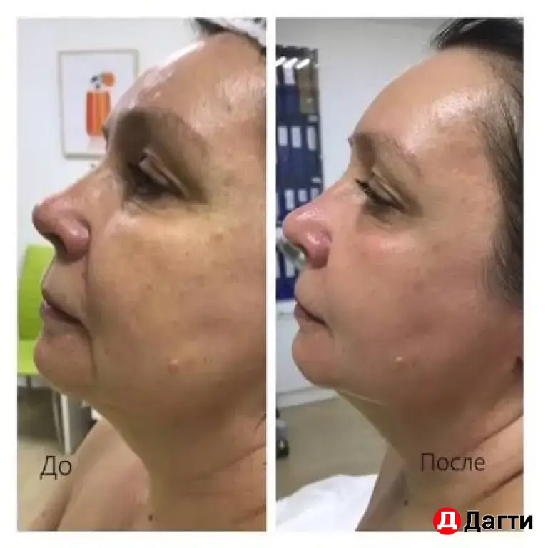 аппаратный массаж