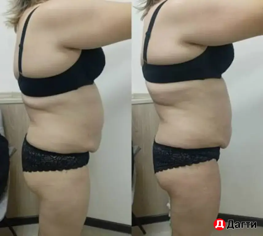 аппаратный массаж