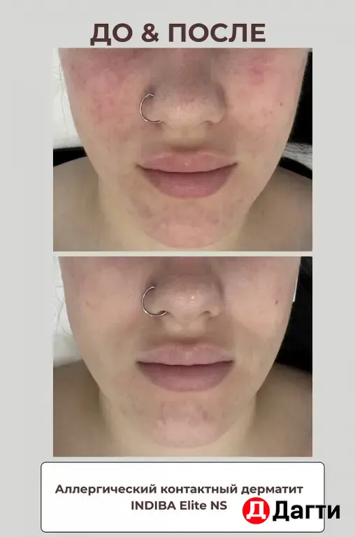 аппаратный массаж