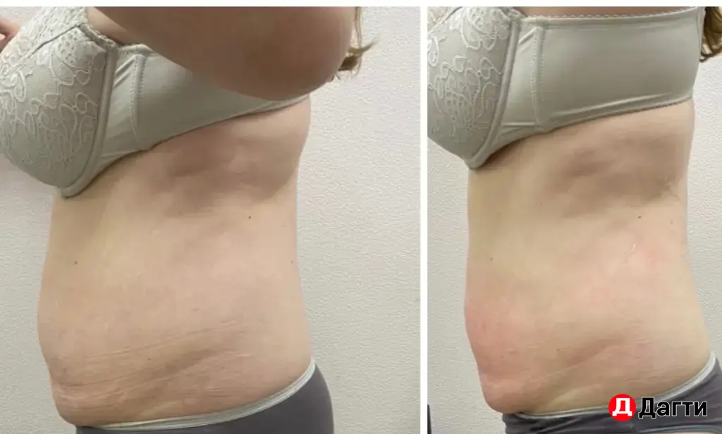 аппаратный массаж